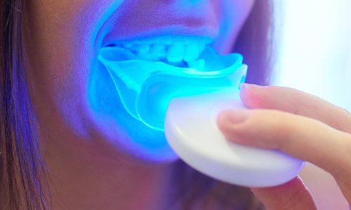 teeth whitening